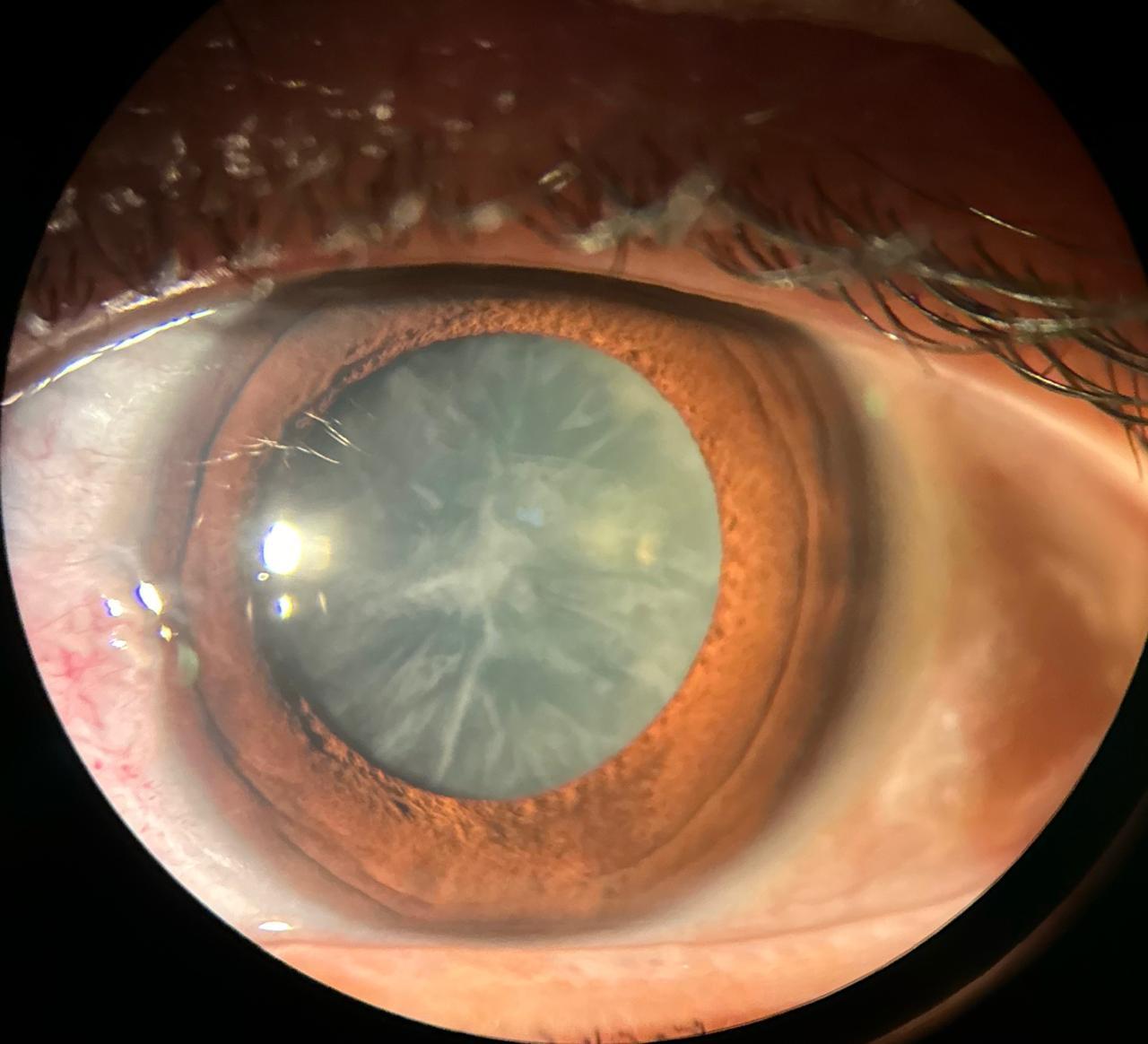 Catarata pode levar à cegueira