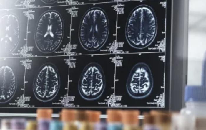Lítio pode ser chave para retardar Alzheimer e envelhecimento cerebral, aponta estudo de Harvard